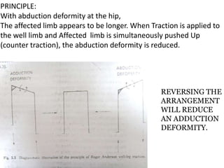 PRINCIPLE:
With abduction deformity at the hip,
The affected limb appears to be longer. When Traction is applied to
the well limb and Affected limb is simultaneously pushed Up
(counter traction), the abduction deformity is reduced.

REVERSING THE
ARRANGEMENT
WILL REDUCE
AN ADDUCTION
DEFORMITY.

 