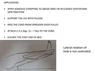APPLICATION:
• APPLY ADHESIVE STRAPPING TO ABOVE KNEE OR IN ELDERLY VENTOFOAM
SKIN TRACTION
• SUPPORT THE LEG WITH PILLOW.
• PASS THE CORD FROM SPREADER OVER PULLEY.
• ATTACH 2.3-3.2kgs (5 – 7 lbs) TO THE CORD.
• ELEVATE THE FOOT END OF BED.

Lateral rotation of
limb is not controlled

 