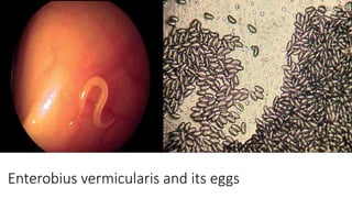 Enterobius vermicularis and its eggs
 