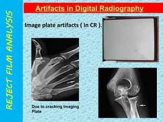 Artifacts in Digital Radiography 
28 
Image plate artifacts ( In CR ). 
Due to cracking Imaging 
Plate 
 