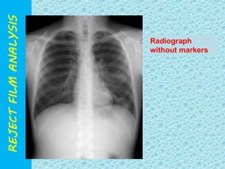 Radiograph 
without markers 
 