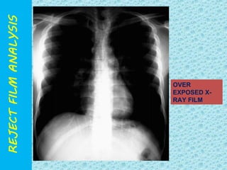 OVER 
EXPOSED X-RAY 
FILM 
 