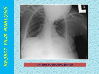 PATIENT POSITONING ERROR 
 