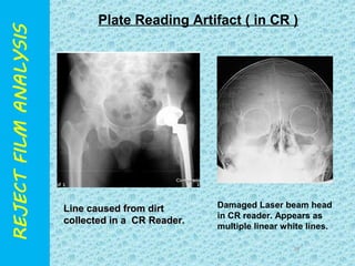 Plate Reading Artifact ( in CR ) 
38 
LLiinnee ccaauusseedd ffrroomm ddiirrtt 
ccoolllleecctteedd iinn aa CCRR RReeaaddeerr. 
Damaged Laser beam head 
in CR reader. Appears as 
multiple linear white lines. 
 