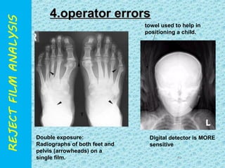 towel used to help in 
positioning a child. 
40 
44..oo pp ee rr aa tt o orr eerrrroorrss 
Digital detector is MORE 
sensitive 
Double exposure: 
Radiographs of both feet and 
pelvis (arrowheads) on a 
single film. 
 