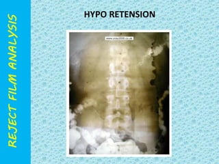 HYPO RETENSION 
 