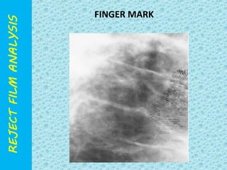 FINGER MARK 
 