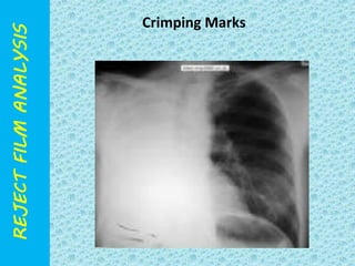 Crimping Marks 
 