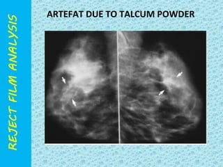 ARTEFAT DUE TO TALCUM POWDER 
 