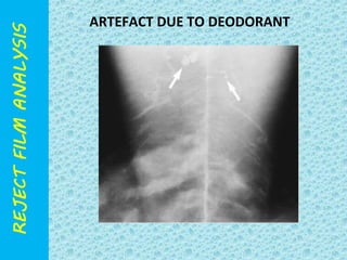 ARTEFACT DUE TO DEODORANT 
 