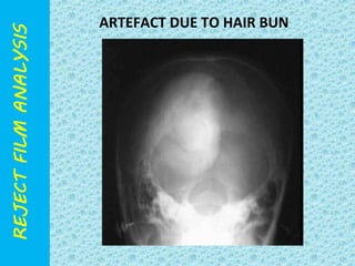 ARTEFACT DUE TO HAIR BUN 
 
