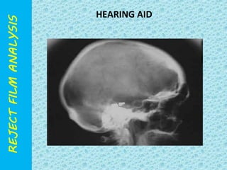 HEARING AID 
 