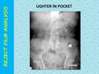LIGHTER IN POCKET 
 