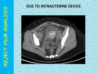 DUE TO INTRAUTERINE DEVICE 
 