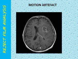 MOTION ARTEFACT 
 