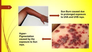 Sun Burn caused due
to prolonged exposure
to UVA and UVB rays.
Hyper-
Pigmentation
caused by the
exposure to Sun
rays.
5
 