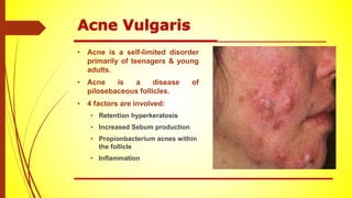 • Acne is a self-limited disorder
primarily of teenagers & young
adults.
• Acne is a disease of
pilosebaceous follicles.
• 4 factors are involved:
• Retention hyperkeratosis
• Increased Sebum production
• Propionbacterium acnes within
the follicle
• Inflammation
 