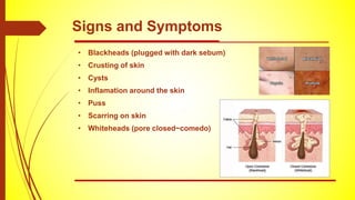 • Blackheads (plugged with dark sebum)
• Crusting of skin
• Cysts
• Inflamation around the skin
• Puss
• Scarring on skin
• Whiteheads (pore closed~comedo)
Signs and Symptoms
 
