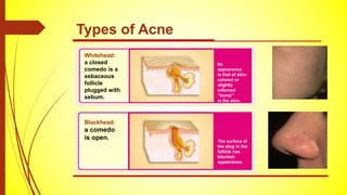 Types of Acne
Whitehead:
a closed
comedo is a
sebaceous
follicle
plugged with
sebum.
Its
appearance
is that of skin-
colored or
slightly
inflamed
“bump”
in the skin.
Blackhead:
a comedo
is open. The surface of
the plug in the
follicle has
blackish
appearance.
 