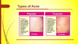 Papules Pustules
Types of Acne
Papules:
a small, solid
lesion slightly
elevated above
the surface of
the skin. It is
caused by
localized
cellular
reaction to the
process of
acne.
Pustules:
a dome-shaped,
fragile lesion
containing pus
that typically
consists of
mixture of
white blood
cells, dead
skin cells and
bacteria.
Papules Pustules
 