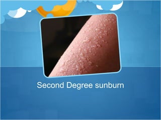 Second Degree sunburn
 