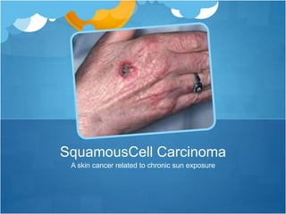 A skin cancer related to chronic sun exposure
SquamousCell Carcinoma
 