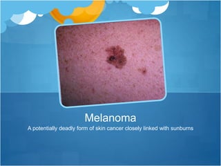 A potentially deadly form of skin cancer closely linked with sunburns
Melanoma
 