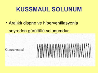 KUSSMAUL SOLUNUM
• Aralıklı dispne ve hiperventilasyonla
seyreden gürültülü solunumdur.
 