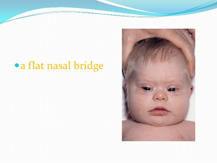 Flat Nasal Bridge And Epicanthal Folds : Flat Nasal Bridge And Epicanthal Folds : Epicanthal Folds ... / The epicanthic fold produces the eye shape characteristic of persons from central and eastern asia;