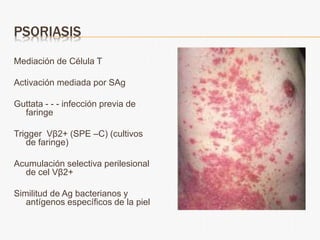PSORIASIS
Mediación de Célula T
Activación mediada por SAg
Guttata - - - infección previa de
faringe
Trigger Vβ2+ (SPE –C) (cultivos
de faringe)
Acumulación selectiva perilesional
de cel Vβ2+
Similitud de Ag bacterianos y
antígenos específicos de la piel
 
