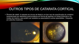 OUTROS TIPOS DE CATARATA CORTICAL
• Àrvore de natal: A catarata em árvore de Natal é um tipo raro de opacificação do cristalino
caracterizado por depósitos policromáticos em forma de agulhas no córtex profundo e no
núcleo do mesmo, que podem ser isolados ou associados a outras opacidades : frequente
em distrofia miotónica.
 