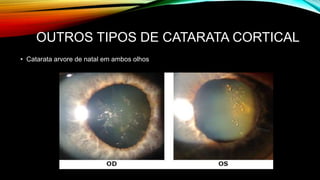 OUTROS TIPOS DE CATARATA CORTICAL
• Catarata arvore de natal em ambos olhos
 