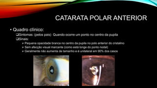 CATARATA POLAR ANTERIOR
• Quadro clínico:
Sintomas: (pelos pais) Quando ocorre um ponto no centro da pupila
Sinais:
 Pequena opacidade branca no centro da pupila no polo anterior do cristalino
 Sem afecção visual marcante (como está longe do ponto nodal)
 Geralmente não aumenta de tamanho e é unilateral em 90% dos casos
 