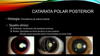 CATARATA POLAR POSTERIOR
• Etiologia: Persistência de artéria hialoide
• Quadro clínico:
 Sintomas: Usualmente não apresenta sintomas
 Sinais: Opacidade em forma de disco no polo posterior
Afecção visual marcante devido à proximidade ao ponto nodal
 