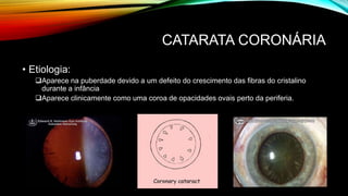 CATARATA CORONÁRIA
• Etiologia:
Aparece na puberdade devido a um defeito do crescimento das fibras do cristalino
durante a infância
Aparece clinicamente como uma coroa de opacidades ovais perto da periferia.
 