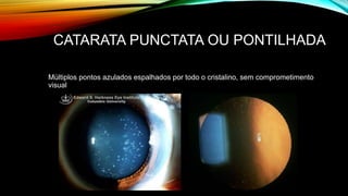 CATARATA PUNCTATA OU PONTILHADA
Múltiplos pontos azulados espalhados por todo o cristalino, sem comprometimento
visual
 