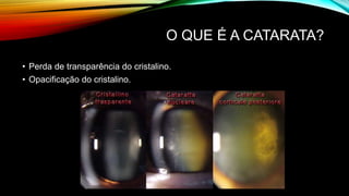 O QUE É A CATARATA?
• Perda de transparência do cristalino.
• Opacificação do cristalino.
 