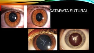 CATARATA SUTURAL
 