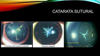 CATARATA SUTURAL
 