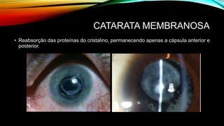 CATARATA MEMBRANOSA
• Reabsorção das proteínas do cristalino, permanecendo apenas a cápsula anterior e
posterior.
 