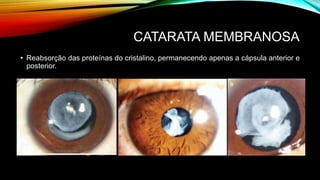CATARATA MEMBRANOSA
• Reabsorção das proteínas do cristalino, permanecendo apenas a cápsula anterior e
posterior.
 