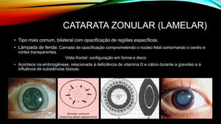 CATARATA ZONULAR (LAMELAR)
• Tipo mais comum, bilateral com opacificação de regiões específicas.
• Lâmpada de fenda: Camada de opacificação comprometendo o núcleo fetal contornando o centro e
córtex transparentes.
Vista frontal: configuração em forma e disco
• Acontece na embriogênese, relacionada à deficiência de vitamina D e cálcio durante a gravidez e à
influência de substâncias tóxicas.
 