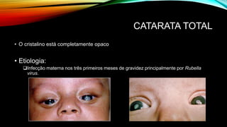 CATARATA TOTAL
• O cristalino está completamente opaco
• Etiologia:
Infecção materna nos três primeiros meses de gravidez principalmente por Rubella
virus.
 