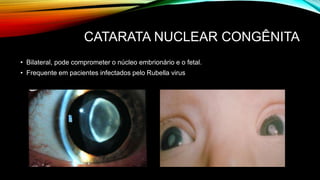 CATARATA NUCLEAR CONGÊNITA
• Bilateral, pode comprometer o núcleo embrionário e o fetal.
• Frequente em pacientes infectados pelo Rubella virus
 