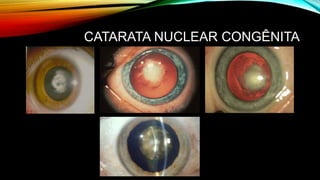 CATARATA NUCLEAR CONGÊNITA
 