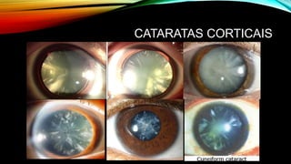 CATARATAS CORTICAIS
 