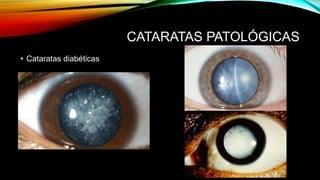 CATARATAS PATOLÓGICAS
• Cataratas diabéticas
 