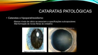 CATARATAS PATOLÓGICAS
• Cataratas e hipoparatireoidismo:
-Baixos níveis de cálcio se associam a opacificações subcapsulares:
Mal-formação de novas fibras do cristalino
 