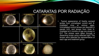 CATARATAS POR RADIAÇÃO
• Typical appearance of freshly excised
lenses from unirradiated control and X-
irradiated mice at various ages.
Unirradiated control lenses are depicted in
panels A-D, and lenses from mice X-
irradiated at 3 months of age are shown in
E-F. The photos were taken through a
dissecting scope using reflected light. The
lenses were selected as representative of
each age and treatment group
 