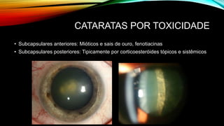 CATARATAS POR TOXICIDADE
• Subcapsulares anteriores: Mióticos e sais de ouro, fenotiacinas
• Subcapsulares posteriores: Tipicamente por corticoesteróides tópicos e sistêmicos
 